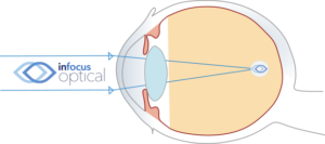 Uncorrected Myopic Eye